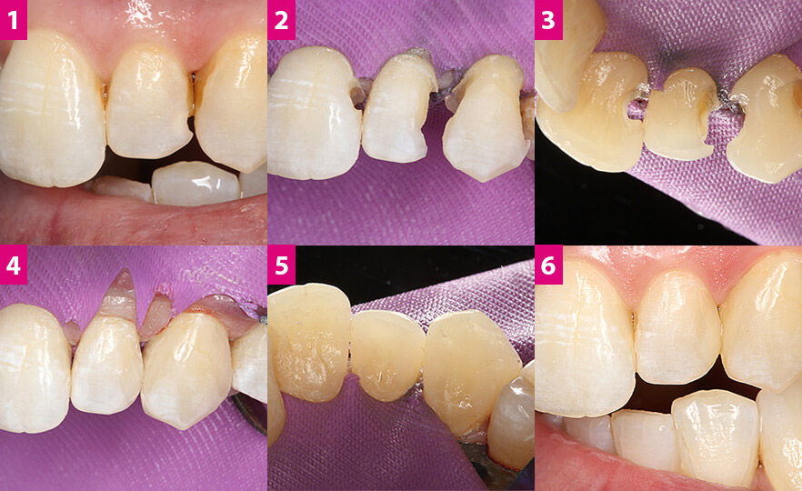 3M Solventum Filtek Easy Match - klinischer Fall in 6 Schritten